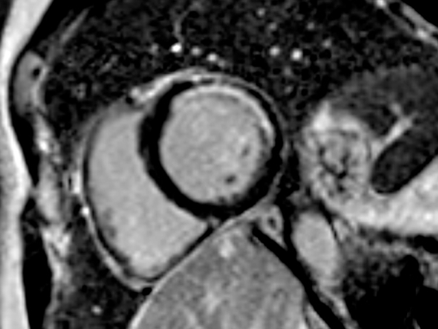Narben (hier ein Herzinfarkt) lassen sich mit der Kernspintomographie des Herzens exzellent erkennen.