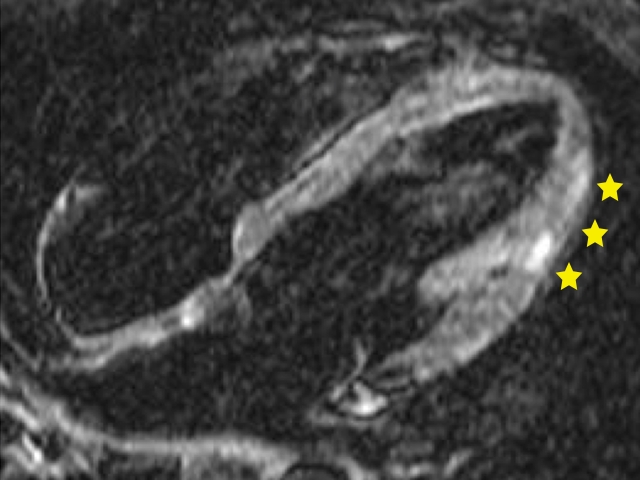 Entzündliche Veränderungen können durch die Kernspintomographie im Herzmuskel erkannt werden.